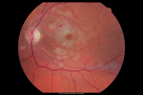 Purtchers Retinopathy with Bilateral Central Retinal Artery Occlusions 
50-year-old man traumatic chest compression and leg crushing injury. OD 1/200, OS 3/200
Schlüsselwörter: purtcher;purtchers;crao;hemorrhage