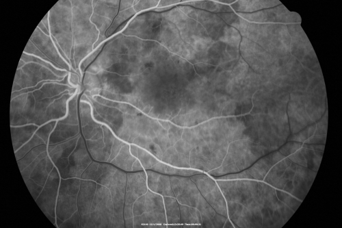 Purtchers Retinopathy with Bilateral Central Retinal Artery Occlusions 
50-year-old man traumatic chest compression and leg crushing injury. OD 1/200, OS 3/200
Keywords: purtcher;purtchers;crao;hemorrhage