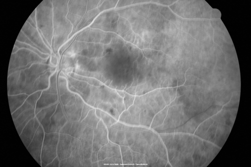 Purtchers Retinopathy with Bilateral Central Retinal Artery Occlusions 
50-year-old man traumatic chest compression and leg crushing injury. OD 1/200, OS 3/200
Keywords: purtcher;purtchers;crao;hemorrhage