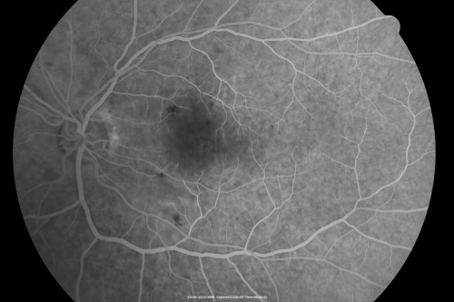 Purtchers Retinopathy with Bilateral Central Retinal Artery Occlusions 
50-year-old man traumatic chest compression and leg crushing injury. OD 1/200, OS 3/200
Mots-clés: purtcher;purtchers;crao;hemorrhage