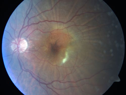 Wet Age-related Macular Degeneration (AMD) Radiating Chorioretinal Folds from Contracting Macular Scar
93-year-old man has wet age-related macular degeneration in his left eye with a subfoveal pigment epithelial detachment.  
 Vision OS is 20/40.   There are striking radiating chorioretinal folds emanating off of the scar, which suggests it is contracting.
