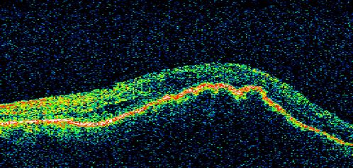 Wet Age-related Macular Degeneration (AMD) Radiating Chorioretinal Folds from Contracting Macular Scar
93-year-old man has wet age-related macular degeneration in his left eye with a subfoveal pigment epithelial detachment.  
 Vision OS is 20/40.   There are striking radiating chorioretinal folds emanating off of the scar, which suggests it is contracting.
