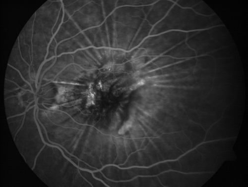 Wet Age-related Macular Degeneration (AMD) Radiating Chorioretinal Folds from Contracting Macular Scar
93-year-old man has wet age-related macular degeneration in his left eye with a subfoveal pigment epithelial detachment.  
 Vision OS is 20/40.   There are striking radiating chorioretinal folds emanating off of the scar, which suggests it is contracting.
