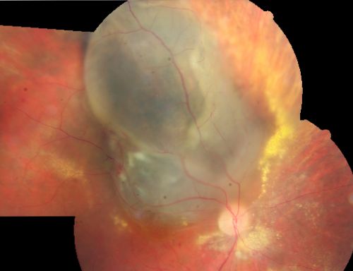 radiationretinopathy_brda01.jpg