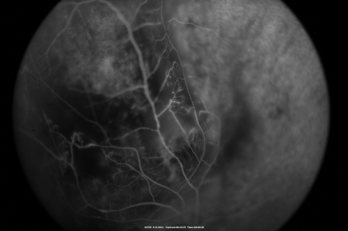 radiationretinopathy_brda14.png