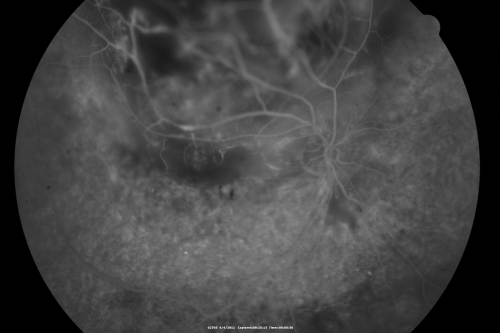 radiationretinopathy_brda16.png