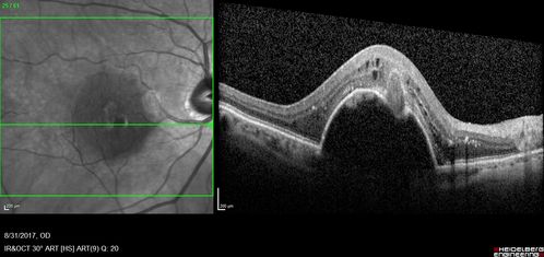 Retinal Angiomatous Proliferation - Type III choroidal neovascular membrane
83 year old female with wet AMD - 20/160 VA- Vision improved to 20/40 with 3 injections of anti-VEGF drugs.  OCT shows break in RPE and FA and ICG show PED with hot spot on ICG
