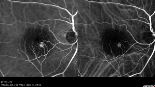 Retinal Angiomatous Proliferation - Type III choroidal neovascular membrane
83 year old female with wet AMD - 20/160 VA- Vision improved to 20/40 with 3 injections of anti-VEGF drugs.  OCT shows break in RPE and FA and ICG show PED with hot spot on ICG

