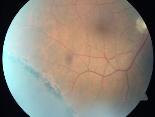 Crystalline retinopathy associated with chronic retinal detachment (Macular Crystals)
54-year-old man with an asymptomatic chronic inferotemporal retinal detachment (10 years old) OD 20/25, OS 20/30
