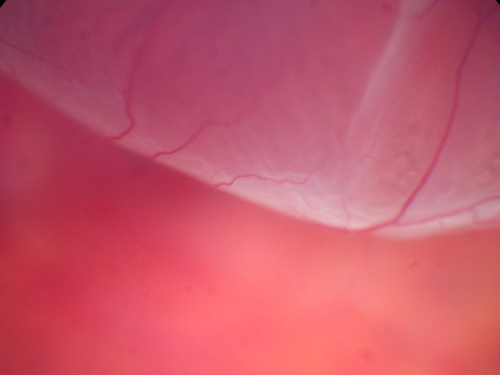 Superior Retinal Detachment - Bullous - Macula-off
70-year-old man  noticed a shadow creeping over the vision in the left eye and he no longer sees well out of that eye.  He had cataract surgery two years ago and a YAG capsulotomy six months ago.  

VISUAL ACUITY:  OD 20/20,  OS 1/200
