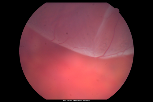 Superior Retinal Detachment - Bullous - Macula-off
70-year-old man  noticed a shadow creeping over the vision in the left eye and he no longer sees well out of that eye.  He had cataract surgery two years ago and a YAG capsulotomy six months ago.  

VISUAL ACUITY:  OD 20/20,  OS 1/200
