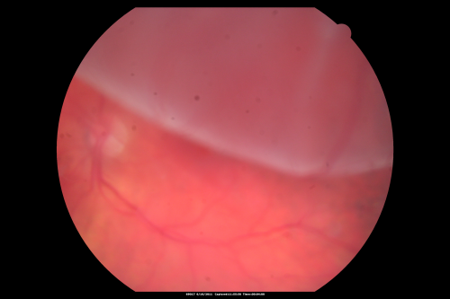 Superior Retinal Detachment - Bullous - Macula-off
70-year-old man  noticed a shadow creeping over the vision in the left eye and he no longer sees well out of that eye.  He had cataract surgery two years ago and a YAG capsulotomy six months ago.  

VISUAL ACUITY:  OD 20/20,  OS 1/200
