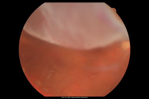 Pseudophakic Macula-Off Retinal Detachment with Larger Retinal Tear
68-year-old woman with veil over her vision just the last few days.  She had cataract surgery a year ago.  OD 20/200 -- One year later vision 20/30!
Keywords: retinal detachment;gas;tear
