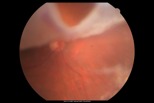 Pseudophakic Macula-Off Retinal Detachment with Larger Retinal Tear
68-year-old woman with veil over her vision just the last few days.  She had cataract surgery a year ago.  OD 20/200 -- One year later vision 20/30!
Keywords: retinal detachment;gas;tear