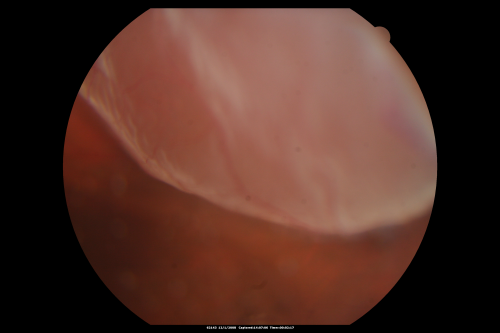 Pseudophakic Macula-Off Retinal Detachment with Larger Retinal Tear
68-year-old woman with veil over her vision just the last few days.  She had cataract surgery a year ago.  OD 20/200 -- One year later vision 20/30!
Keywords: retinal detachment;gas;tear