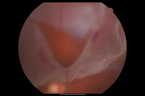 Pseudophakic Macula-Off Retinal Detachment with Larger Retinal Tear
68-year-old woman with veil over her vision just the last few days.  She had cataract surgery a year ago.  OD 20/200 -- One year later vision 20/30!
Keywords: retinal detachment;gas;tear