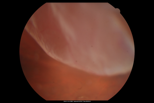Pseudophakic Macula-Off Retinal Detachment with Larger Retinal Tear
68-year-old woman with veil over her vision just the last few days.  She had cataract surgery a year ago.  OD 20/200 -- One year later vision 20/30!
Keywords: retinal detachment;gas;tear