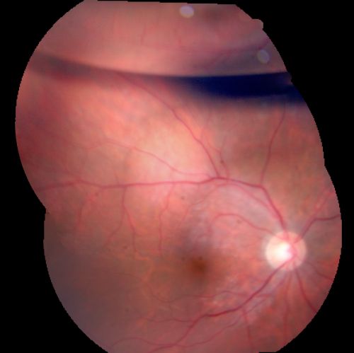 Pseudophakic Macula-Off Retinal Detachment with Larger Retinal Tear
68-year-old woman with veil over her vision just the last few days.  She had cataract surgery a year ago.  OD 20/200 -- One year later vision 20/30!
Keywords: retinal detachment;gas;tear