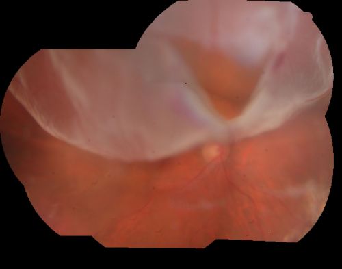 Pseudophakic Macula-Off Retinal Detachment with Larger Retinal Tear
68-year-old woman with veil over her vision just the last few days.  She had cataract surgery a year ago.  OD 20/200 -- One year later vision 20/30!
Keywords: retinal detachment;gas;tear