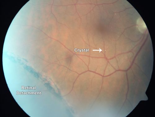 Crystalline retinopathy associated with chronic retinal detachment (Macular Crystals)
54-year-old man with an asymptomatic chronic inferotemporal retinal detachment (10 years old) OD 20/25, OS 20/30
