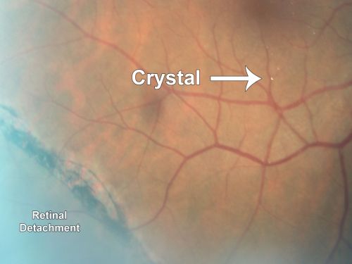 Crystalline retinopathy associated with chronic retinal detachment (Macular Crystals)
54-year-old man with an asymptomatic chronic inferotemporal retinal detachment (10 years old) OD 20/25, OS 20/30

