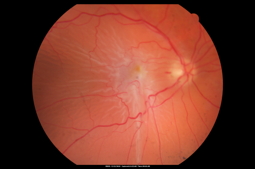 Retinal Detachment and Macular Pucker 
76-year-old man has had a retinal detachment repair in the right eye.  His vision was improving until just on the way over today and then his vision declined. 

VISUAL ACUITY:  OD 1/200
