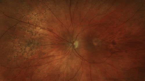 Reticular peripheral pigment degeneration
