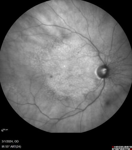 Reticular pseudodrusen
