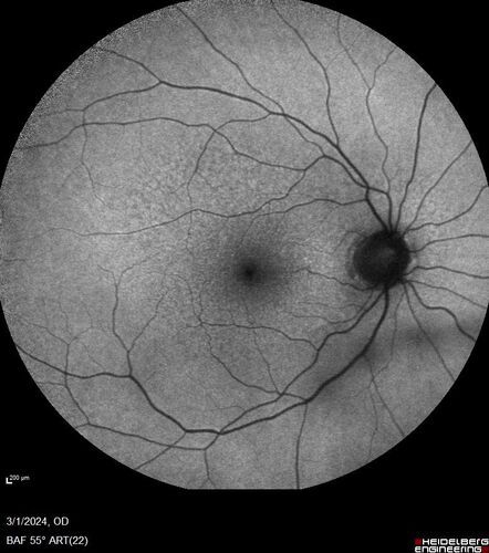 Reticular pseudodrusen
