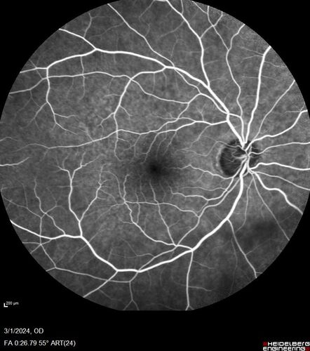 Reticular pseudodrusen
