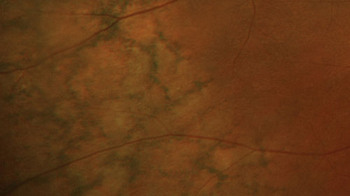 Reticular pigment degeneration
78 year old man with wet AMD- Peripheral retina show reticular pigment degeneration
