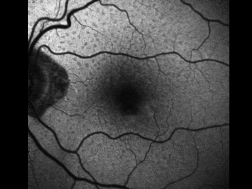 Reticular Macular Disease (Pseudo-drusen) Both Eyes - Wet AMD OS - Dry AMD OD FAF
84-year-old woman has wet age-related macular degeneration in the left eye and dry macular degeneration in the right eye.  She takes the eye vitamins and her vision is stable since she was treated three months ago with Avastin.   OD 20/50,  OS 20/32

