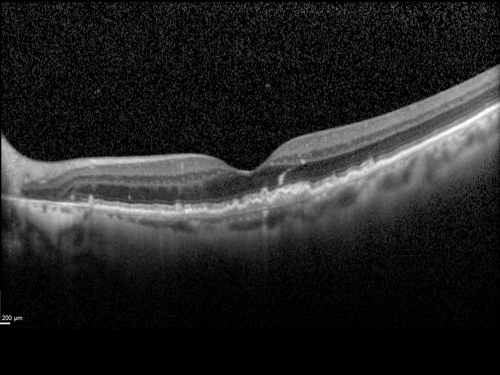 Reticular Macular Disease (Pseudo-drusen) Both Eyes - Wet AMD OS - Dry AMD OD SD-OCT
84-year-old woman has wet age-related macular degeneration in the left eye and dry macular degeneration in the right eye.  She takes the eye vitamins and her vision is stable since she was treated three months ago with Avastin.   OD 20/50,  OS 20/32
