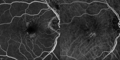 Reticular Macular Disease (Pseudo-drusen) Both Eyes - Wet AMD OS - Dry AMD OD FA and ICG early
84-year-old woman has wet age-related macular degeneration in the left eye and dry macular degeneration in the right eye.  She takes the eye vitamins and her vision is stable since she was treated three months ago with Avastin.   OD 20/50,  OS 20/32
