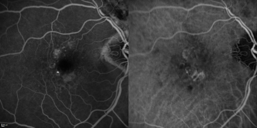 Reticular Macular Disease (Pseudo-drusen) Both Eyes - Wet AMD OS - Dry AMD OD FA and ICG late
84-year-old woman has wet age-related macular degeneration in the left eye and dry macular degeneration in the right eye.  She takes the eye vitamins and her vision is stable since she was treated three months ago with Avastin.   OD 20/50,  OS 20/32
