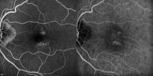 Reticular Macular Disease (Pseudo-drusen) Both Eyes - Wet AMD OS - Dry AMD OD  FA and ICG late
84-year-old woman has wet age-related macular degeneration in the left eye and dry macular degeneration in the right eye.  She takes the eye vitamins and her vision is stable since she was treated three months ago with Avastin.   OD 20/50,  OS 20/32
