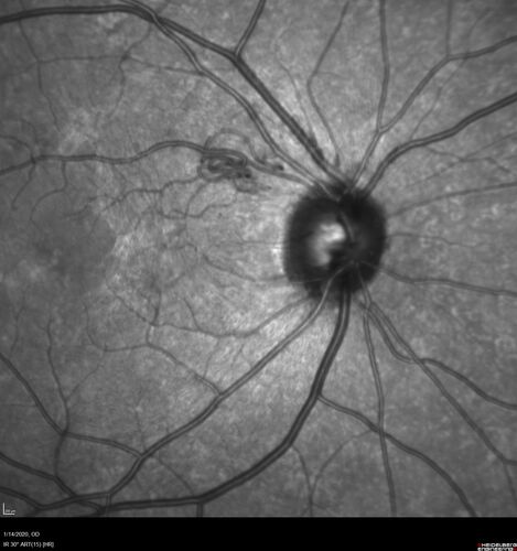 Type 1 Retinal Arteriovenous Malformation
42 year old female VA 20/32 OD, 20/20 OS MRI was negative.
