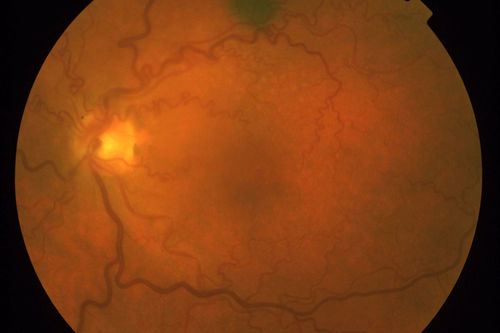 50 Year Old woman with Congenital Retinal Vascular Tortuosity - Normal Vision
