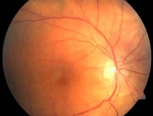 Birdshot Chorioretintis and PAMM
Patient presented with paracentral acute middle maculopathy as the presenting symptom of birdshot.  This case was published. RETINAL CASES & BRIEF REPORTS 10:151â€“153, 2016.
