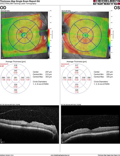 Birdshot Chorioretintis and PAMM
Patient presented with paracentral acute middle maculopathy as the presenting symptom of birdshot.  This case was published. RETINAL CASES & BRIEF REPORTS 10:151â€“153, 2016.
