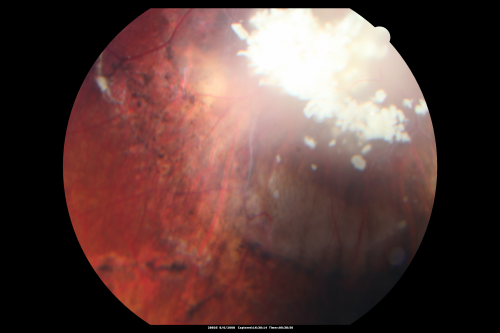Retinoblastoma - Bilateral - Regressed - Chemotherapy, Thermal Therapy, Cryotherapy
10-year-old child was seen in the office on August 6, 2008.  She was treated with a combination of chemotherapy at 10 months old as well as thermal therapy and cryotherapy for bilateral retinoblastoma tumors.  She reportedly had nine tumors in the left eye and five tumors in the right eye
Keywords: retinoblastoma