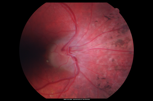Retinoblastoma - Bilateral - Regressed - Chemotherapy, Thermal Therapy, Cryotherapy
10-year-old child was seen in the office on August 6, 2008.  She was treated with a combination of chemotherapy at 10 months old as well as thermal therapy and cryotherapy for bilateral retinoblastoma tumors.  She reportedly had nine tumors in the left eye and five tumors in the right eye
Keywords: retinoblastoma