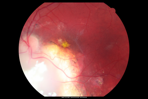 Retinoblastoma - Bilateral - Regressed - Chemotherapy, Thermal Therapy, Cryotherapy
10-year-old child was seen in the office on August 6, 2008.  She was treated with a combination of chemotherapy at 10 months old as well as thermal therapy and cryotherapy for bilateral retinoblastoma tumors.  She reportedly had nine tumors in the left eye and five tumors in the right eye
Keywords: retinoblastoma