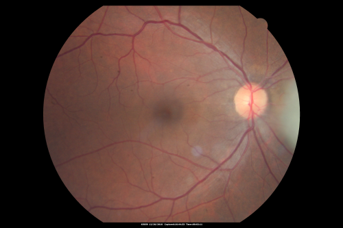 Retinocytoma - Retinoma - Regressed Retinoblastoma 43 year old male incidental finding 
