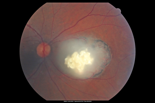 Retinocytoma - Retinoma - Regressed Retinoblastoma 43 year old male incidental finding 
