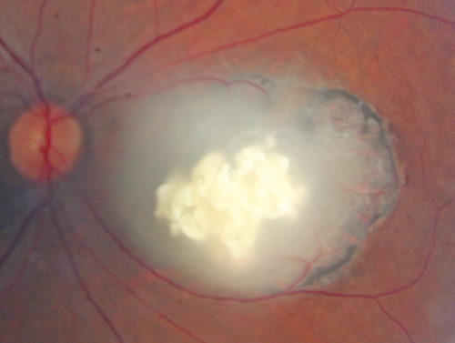 Retinocytoma - Retinoma - Regressed Retinoblastoma 43 year old male incidental finding 
