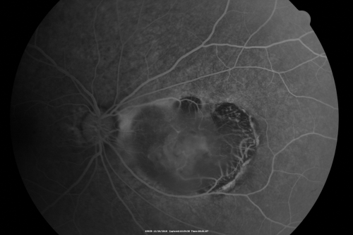 Retinocytoma - Retinoma - Regressed Retinoblastoma 43 year old male incidental finding 
