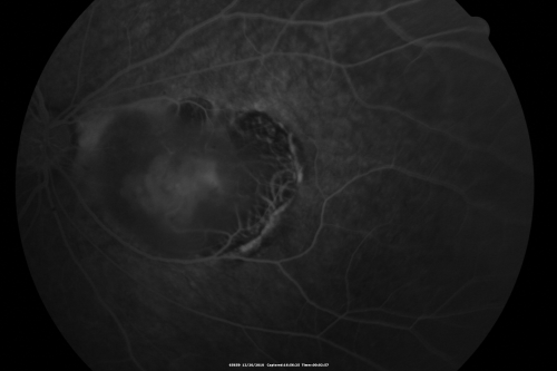 Retinocytoma - Retinoma - Regressed Retinoblastoma 43 year old male incidental finding 
