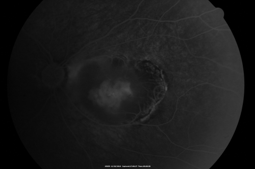Retinocytoma - Retinoma - Regressed Retinoblastoma 43 year old male incidental finding 
