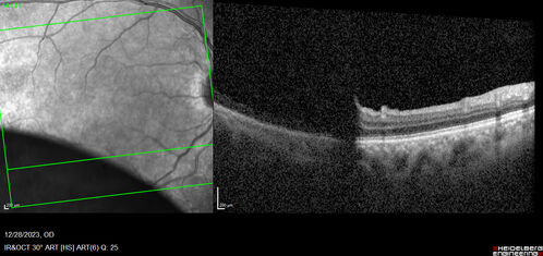 Bullous Retinoschisis - Asymptomatic
